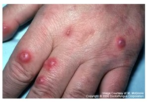 クリプトコックス症